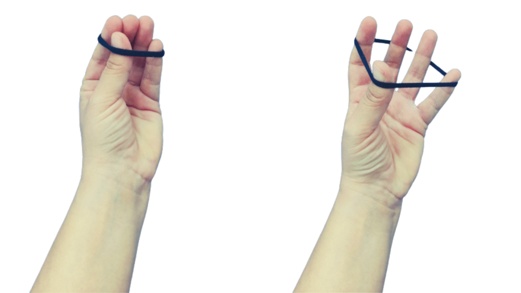 Síndrome del túnel carpiano