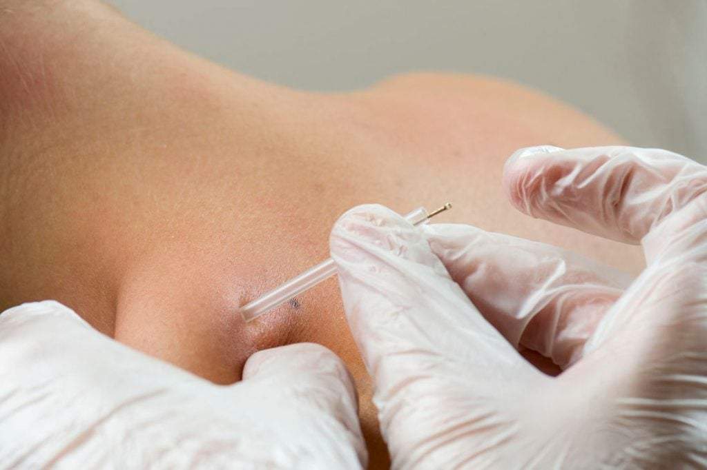 Punción seca en fisioterapia